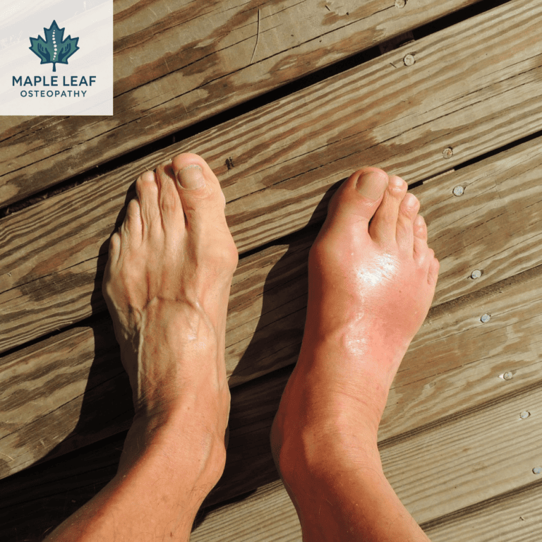 Ankle strain