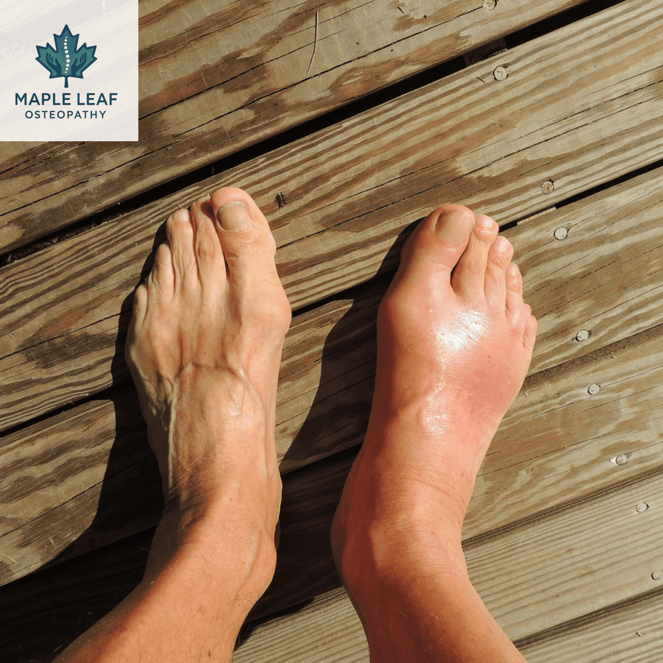 Ankle strain